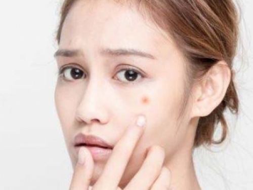 痘痘肌肤怎么改善？